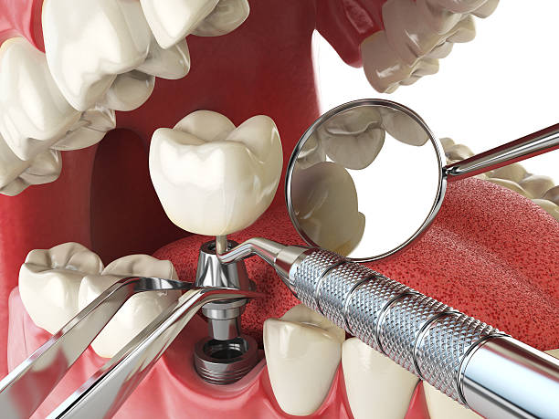 Best Emergency Root Canal Treatment in Dekal, IL